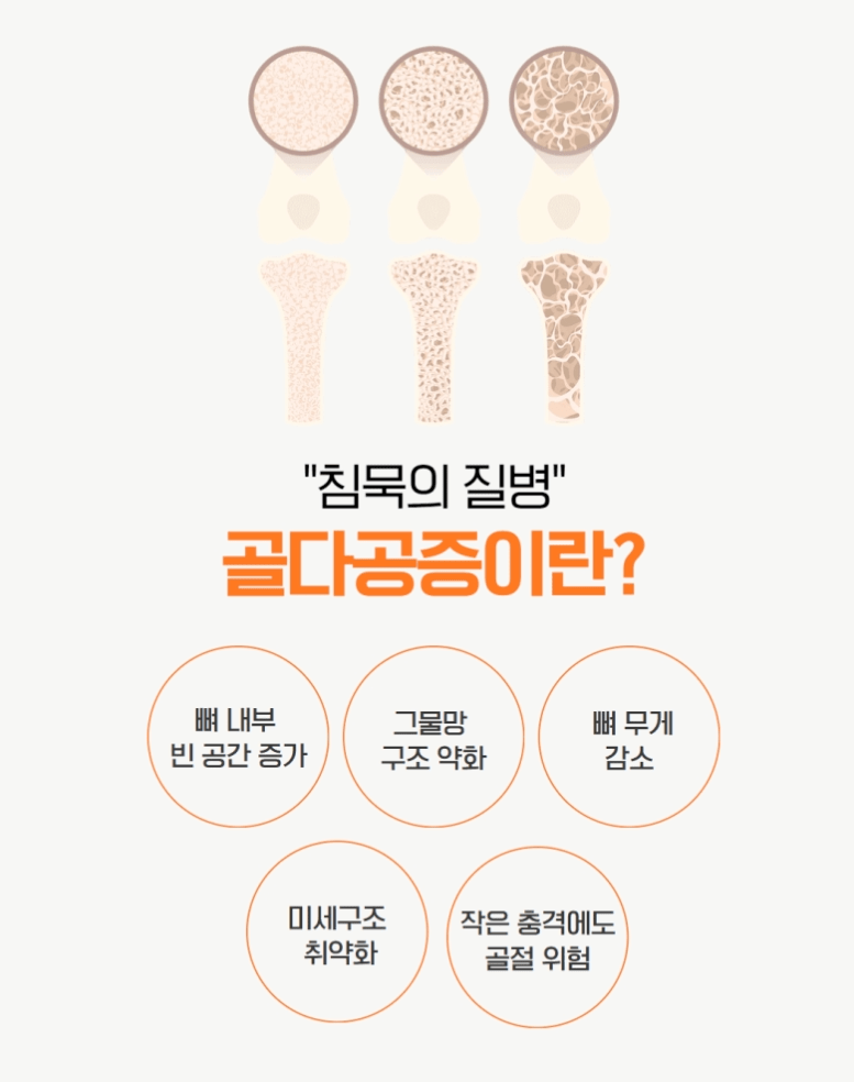 골다공증