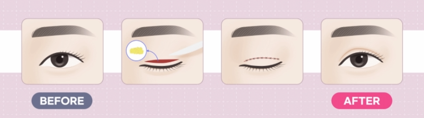 매몰과 절개의 진짜 차이