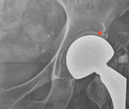 고관절재치환술