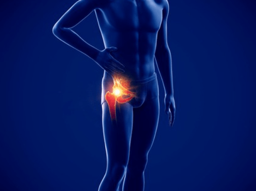 고관절재치환술