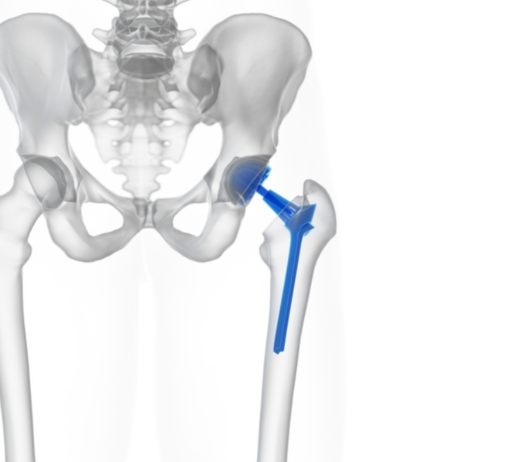 고관절재치환술