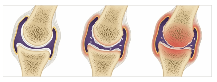퇴행성관절염치료