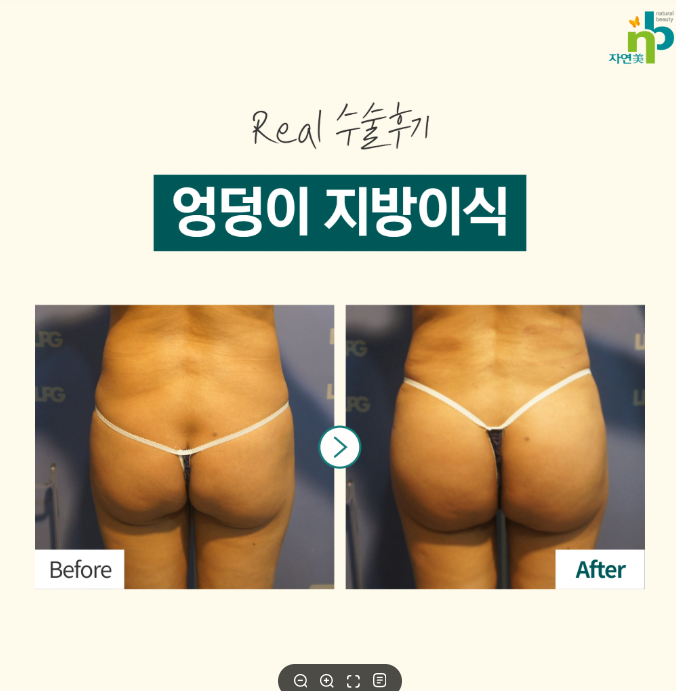 힙딥 지방이식 전후