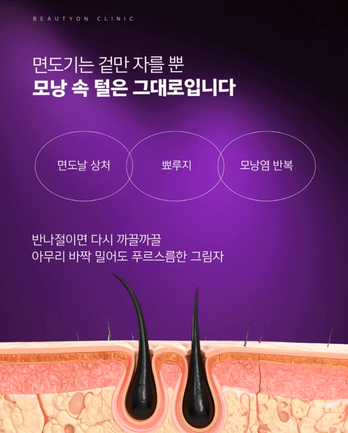 수염제모레이저