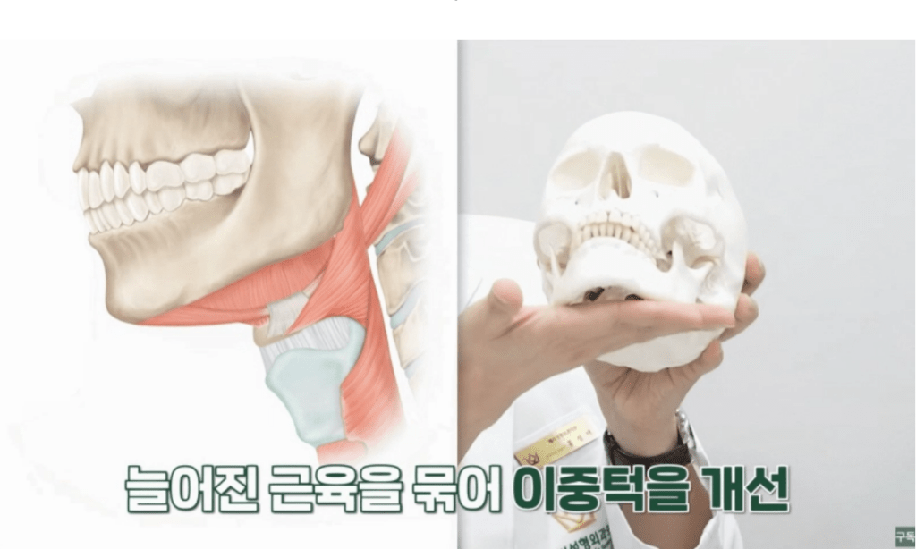 이중턱근육묶기