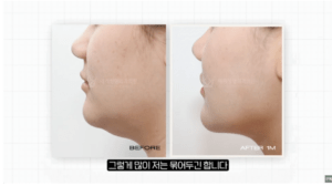 이중턱근육묶기