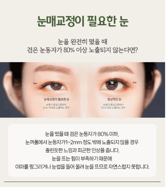 비절개눈매교정
