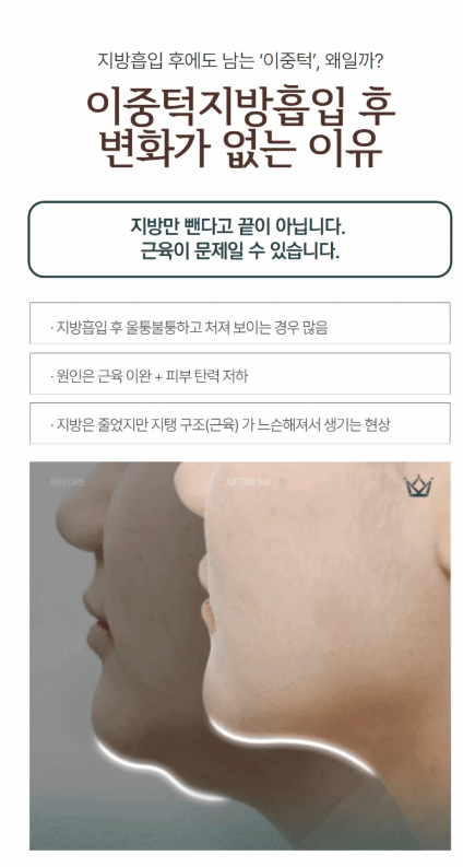 강남이중턱근육묶기